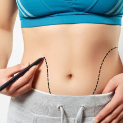 Abdominoplasty – Procedure, cost, pros, and cons
