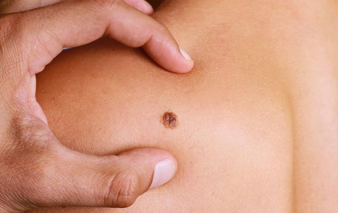 4 common types of melanoma and their treatment options