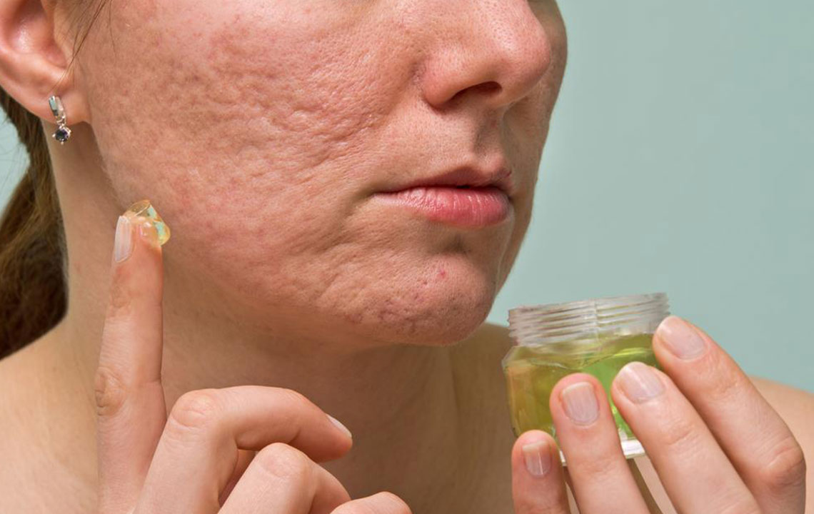 6 useful tips to treat acne scars, marks, and blemishes