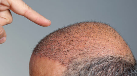 3 popular hair transplants and their cost in India