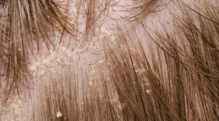 A brief overview of scalp psoriasis