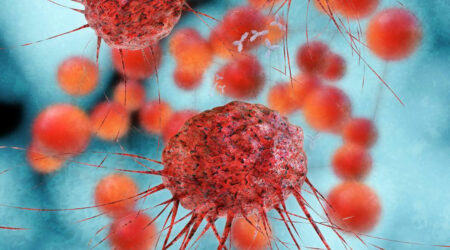 Everything you need to know about metastatic ovarian cancer