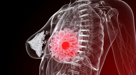 Five things you need to know about breast cancer