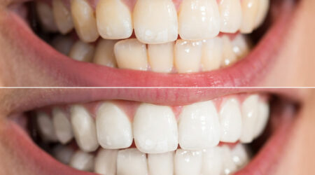 Here’s what you need to know about teeth whitening procedure