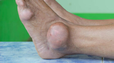 Preventive care for dealing with gout foot pain