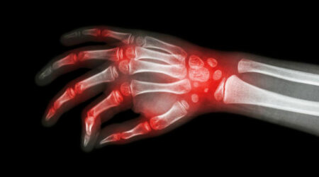 Rheumatoid arthritis and lupus – what makes them similar?