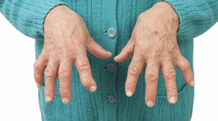 Types of arthritis and ways to deal with them