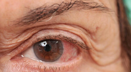 Ways of dealing with chronic dry eye disease