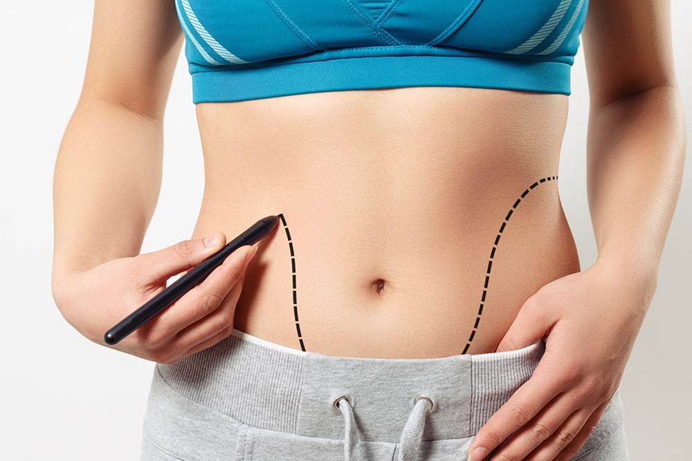 Abdominoplasty &#8211; Procedure, cost, pros, and cons