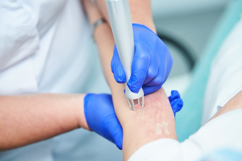 6 crucial things to know about tattoo removal procedures